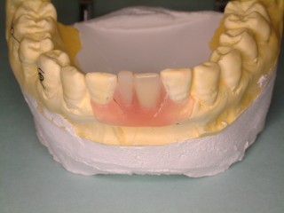 少数歯欠損のノンクラスプデンチャーが口腔内に入るまで1