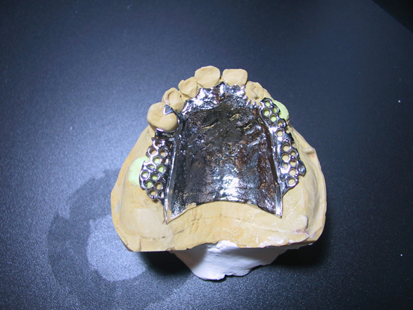 ノンクラスプ用金属床。鈎歯の舌側は、キャストハーフ鈎で持ってきた方がよいケースもありますが、この場合鈎歯が短かった為、メタルアップにしました。