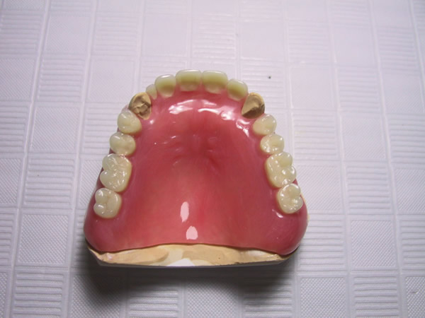 多数歯欠損でのルシトーンＦＲＳ。口蓋の厚さは、通常の義歯と同等。たわみが出ない程度に